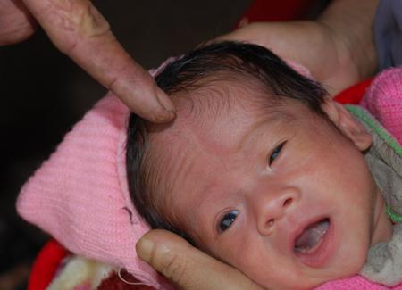 Lạ lùng căn bệnh mở hộp sọ